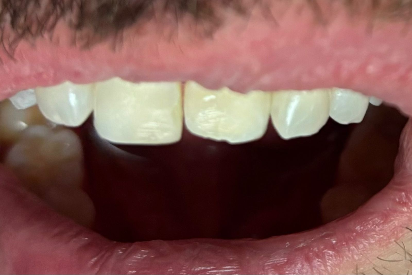 Resina dental en Monterrey: dientes frontales superiores antes del tratamiento con resina