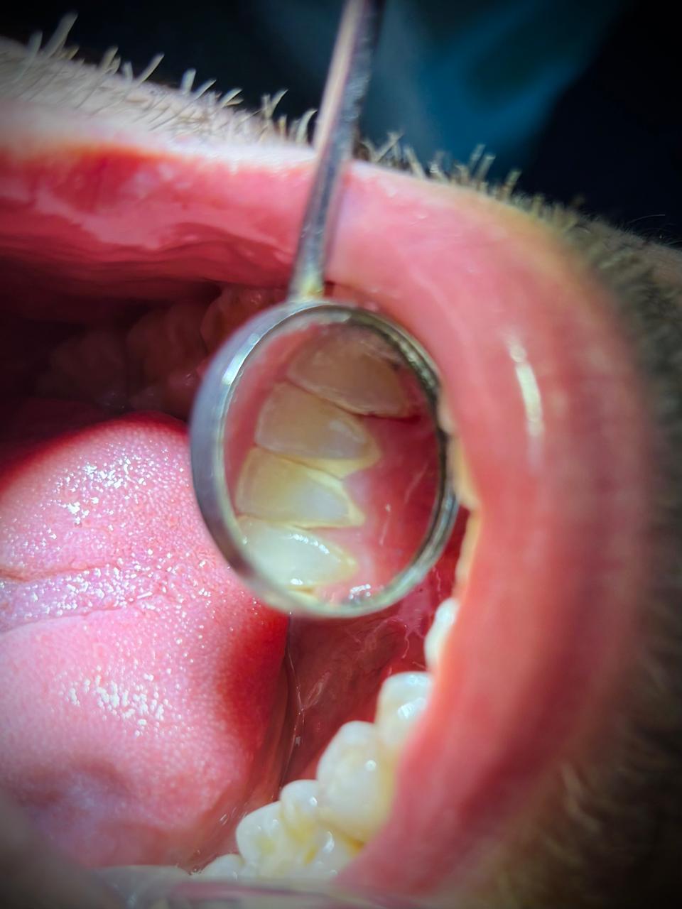 Limpieza dental en Monterrey: vista con espejo dental de cara lingual de incisivos inferiores