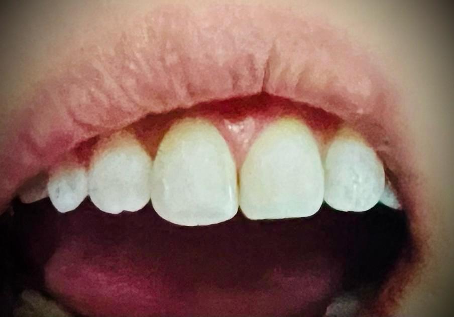 Resina dental antes del tratamiento: diente con caries que será restaurado con composite en el consultorio de la Dra. Yadira Garza en Monterrey