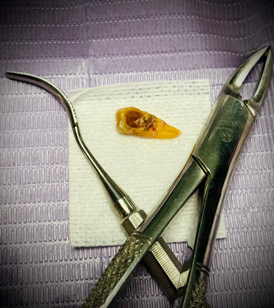 Molar extraído con caries visible: pieza dental con daño extenso por caries no tratada, extraída en el consultorio de Especialidades Dentales Monterrey