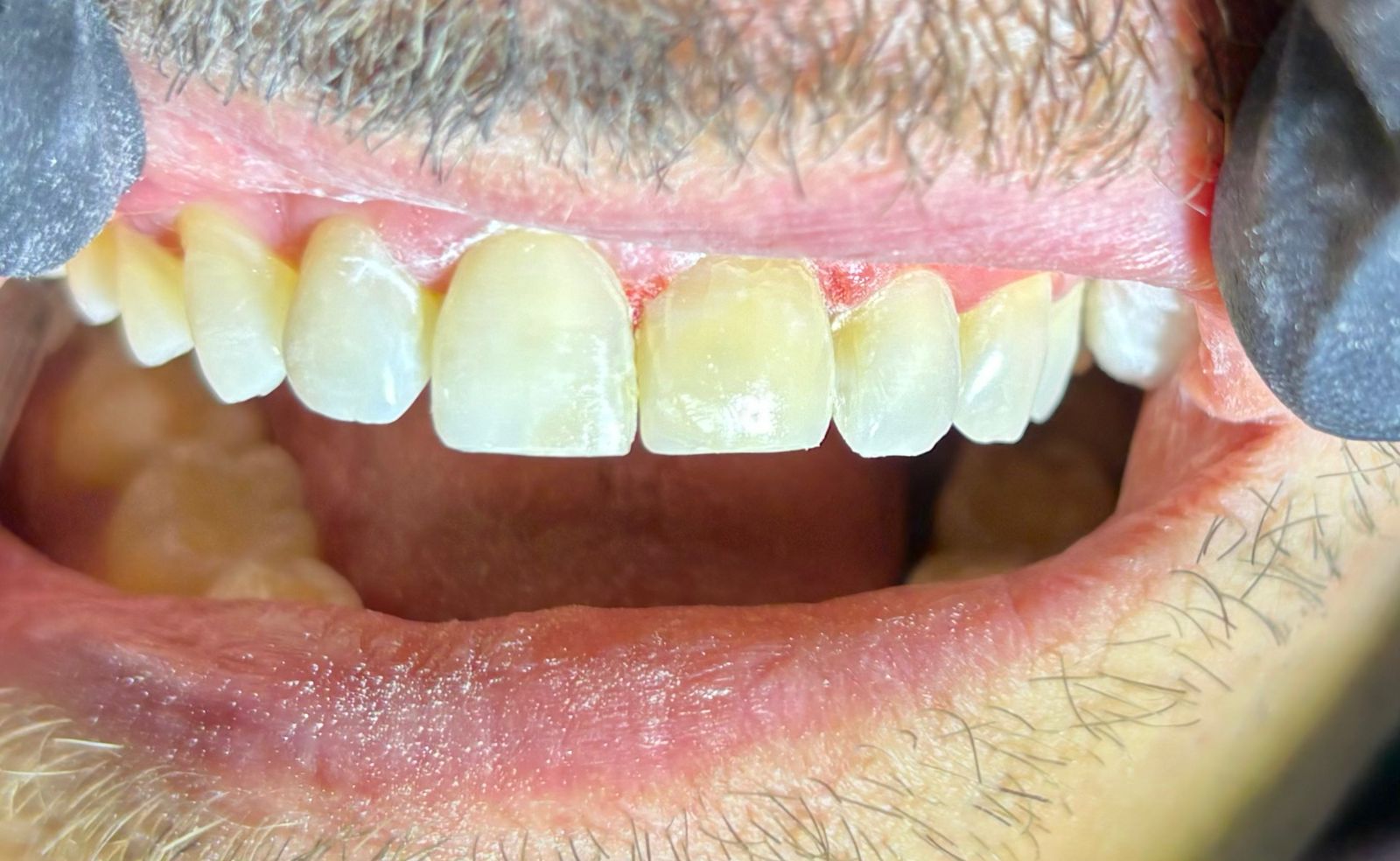 Sonrisa con tratamiento estético dental en Monterrey