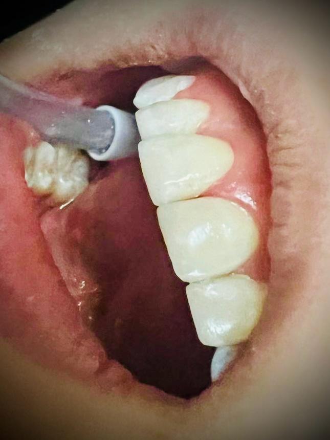 Porcelain veneers and composite resin restorations comparison by Dr. Yadira Garza