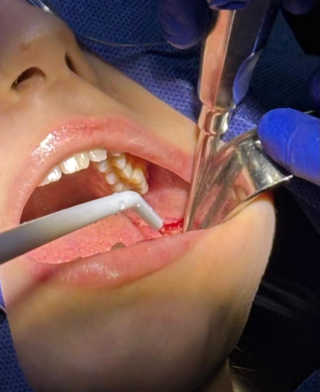 Cirujano dentista en Monterrey: especialista maxilofacial con lupas operando en quirófano
