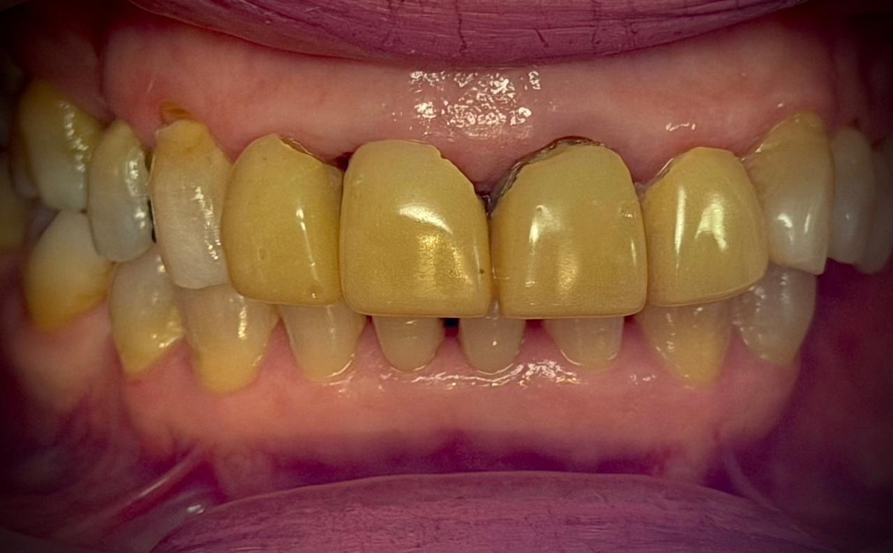 Dental crown options comparison showing zirconia, porcelain, and PFM crowns by Dr. Yadira Garza in Monterrey