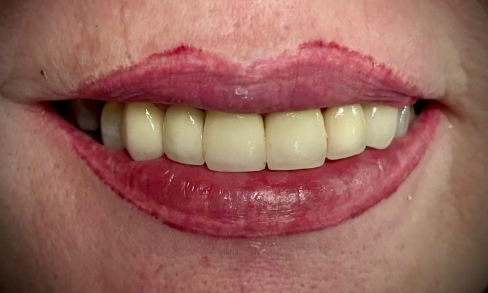 Coronas dentales: zirconio, porcelana o metal-cerámicas