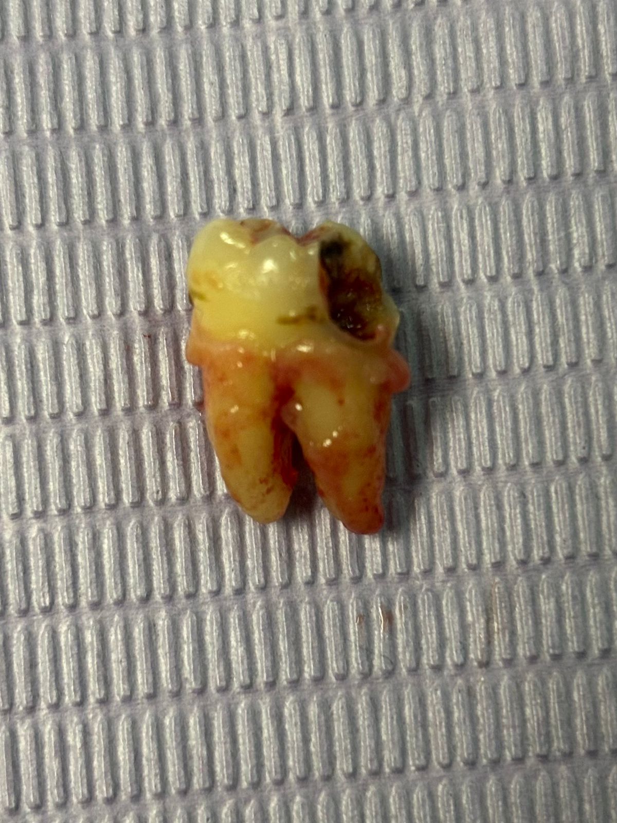 Extracción de muelas en Monterrey: molar extraído con dos raíces y caries extensa sobre gasa
