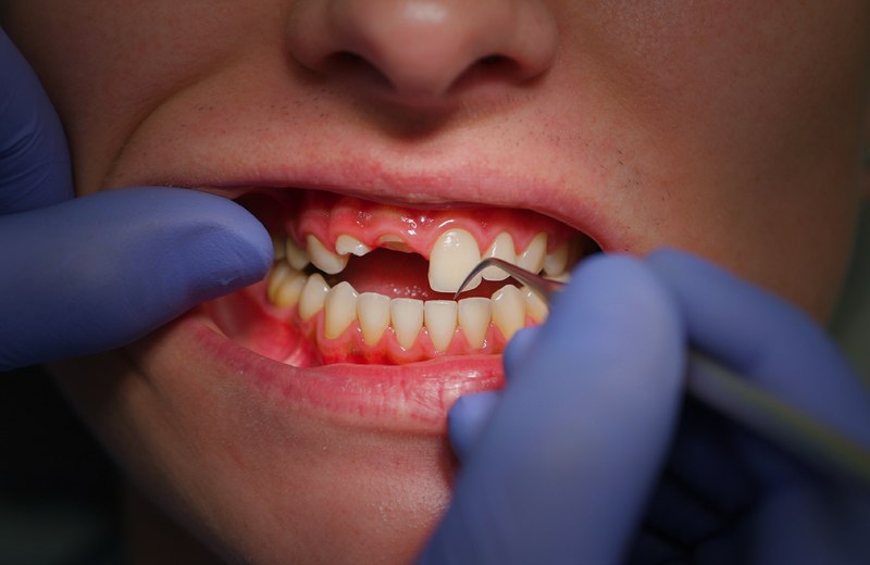 Exploración periodontal en Monterrey: encías enrojecidas e inflamadas por gingivitis, revisadas con sonda dental durante consulta en Especialidades Dentales
