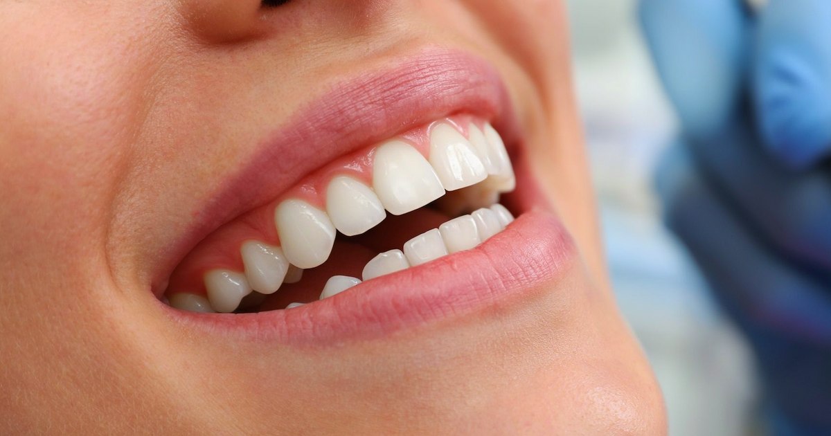 Gingivitis en Monterrey: síntomas, tratamiento y cómo revertirla a tiempo, con la Dra. Yadira Garza