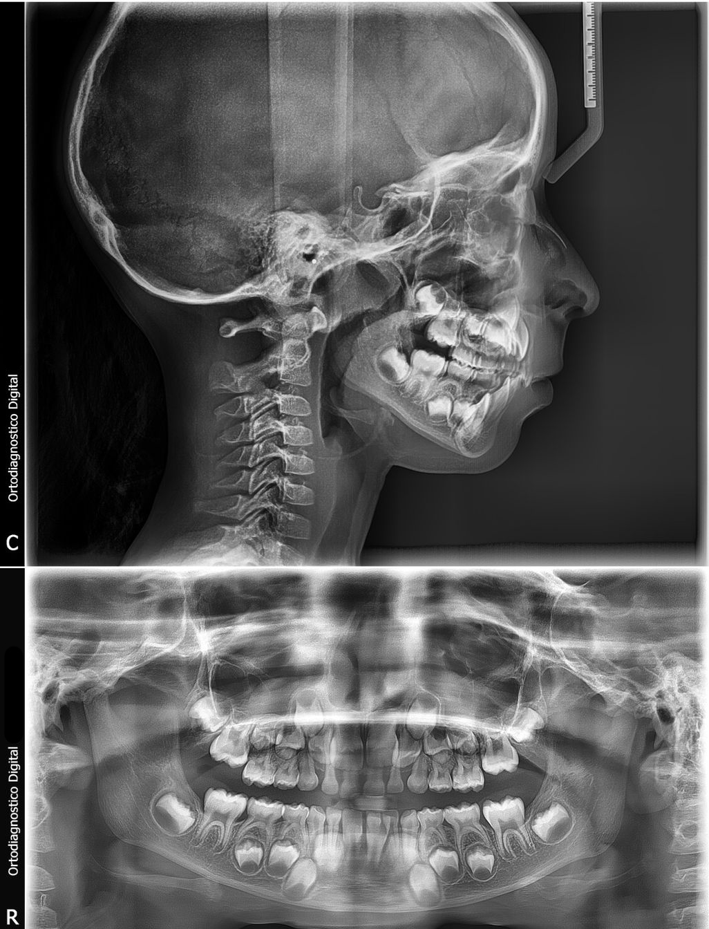 Dental implant surgery procedure illustration by Dr. Yadira Garza in Monterrey