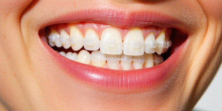 Brackets estéticos de cerámica color diente — segundo ángulo