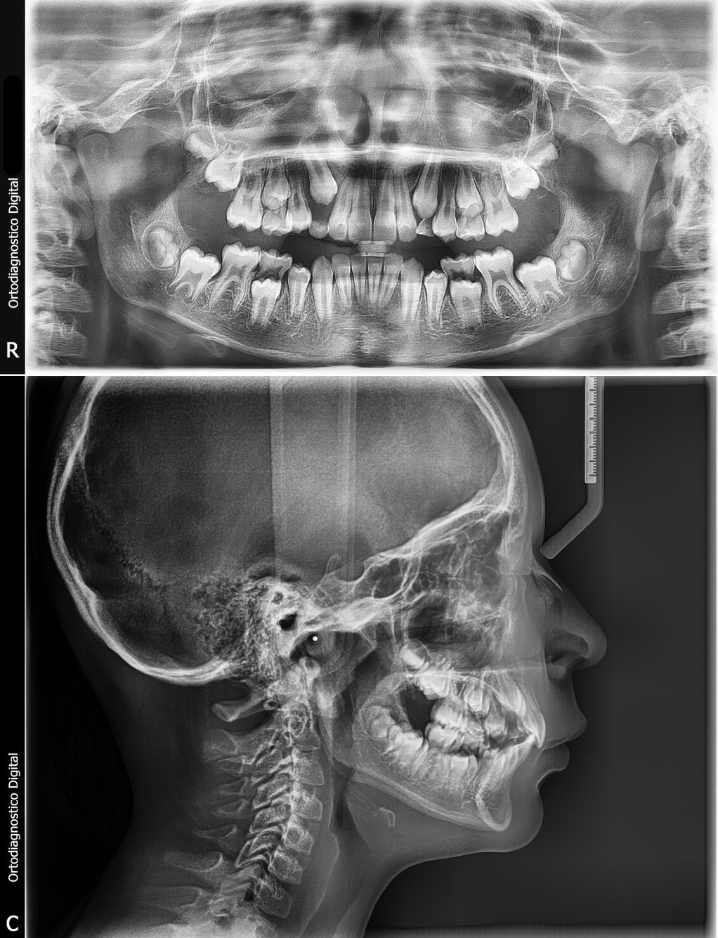 Radiografía panorámica y cefalométrica combinadas mostrando dentición mixta en un paciente joven