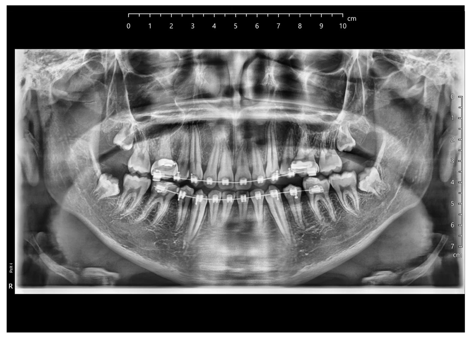Radiografía panorámica que muestra ortodoncia y terceros molares (muelas del juicio) en posición impactada