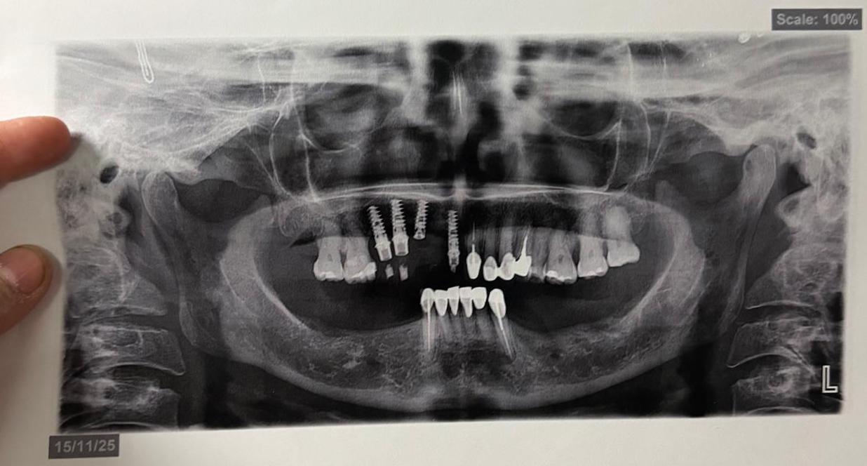 Radiografía panorámica que muestra implantes dentales osteointegrados en maxilar inferior y superior