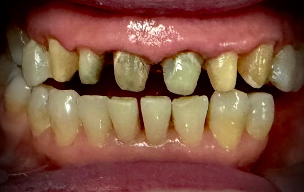 Retratamiento de endodoncia y pilares para coronas dentales