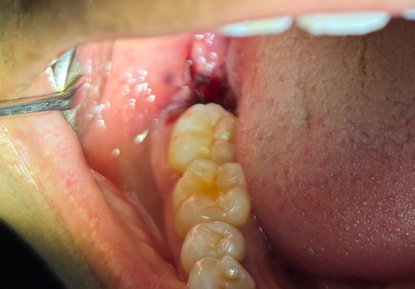 Extracción de muelas en zona posterior en Especialidades Dentales Monterrey