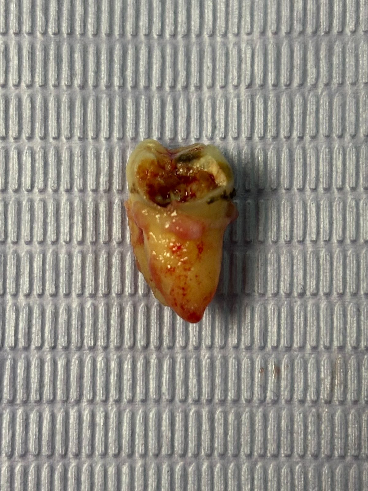 Molar extraído con caries visible sobre gasa estéril