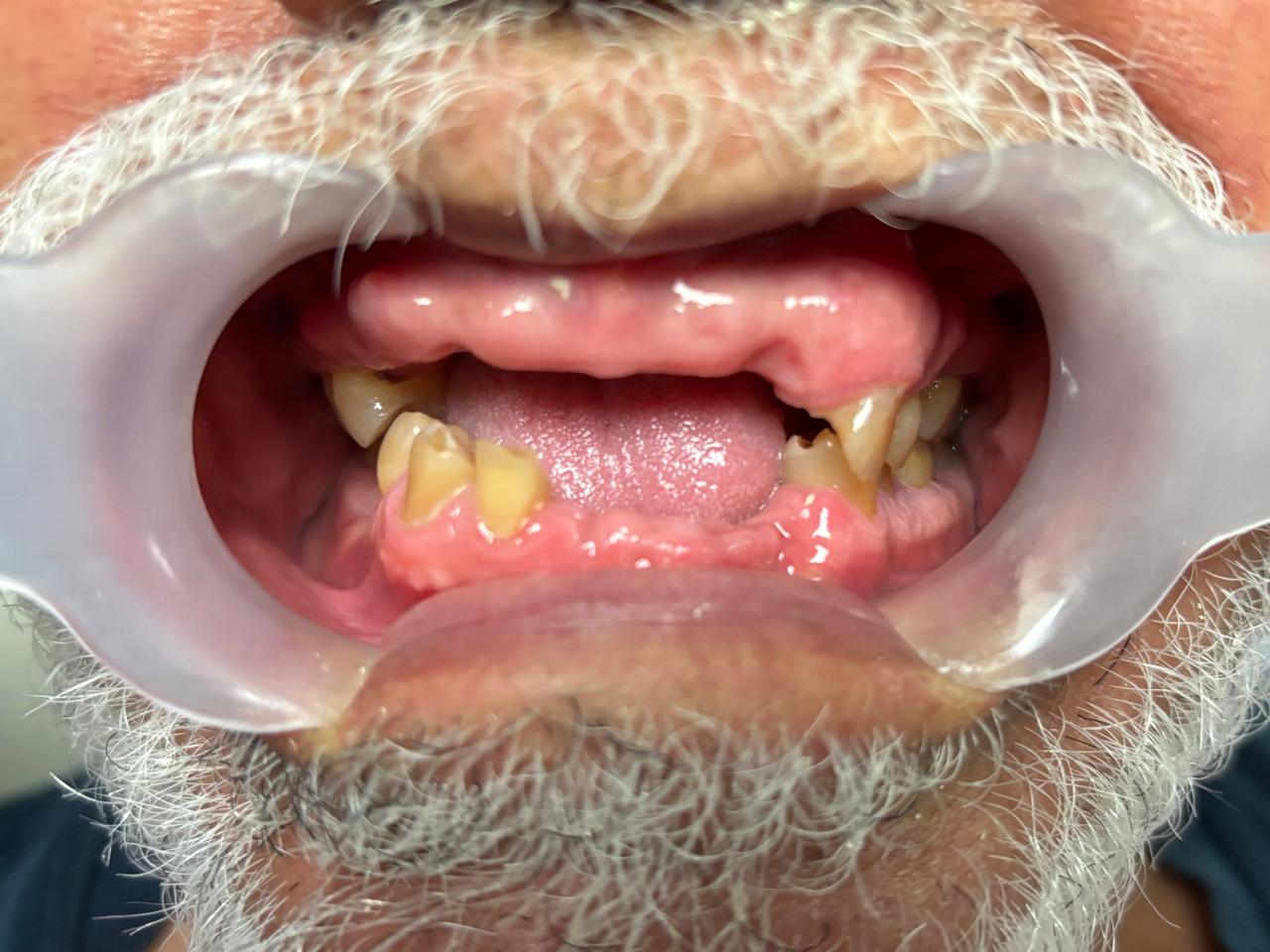 Dientes desgastados antes de tratamiento con implantes dentales