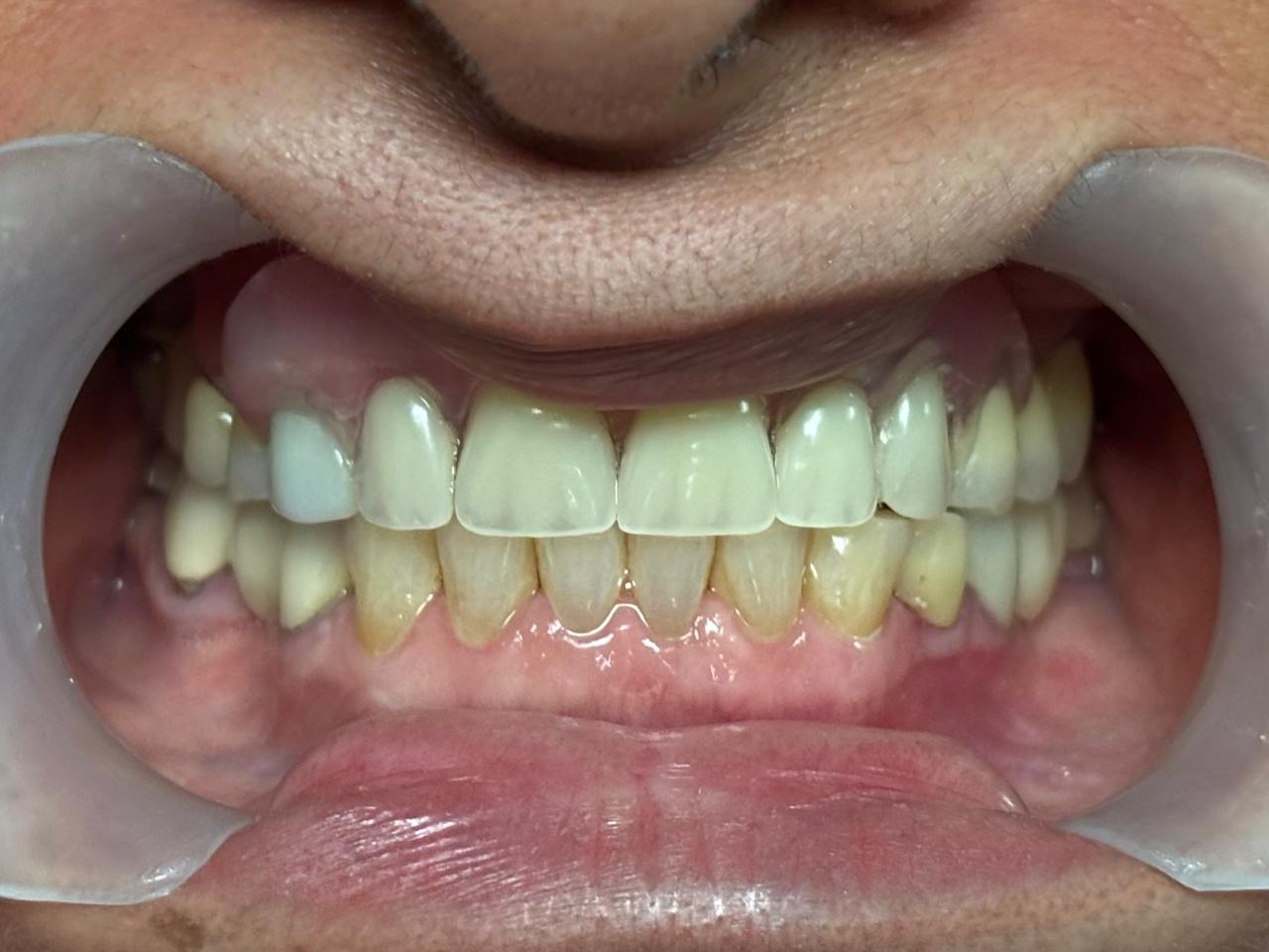 Dientes restaurados después de tratamiento con implantes dentales