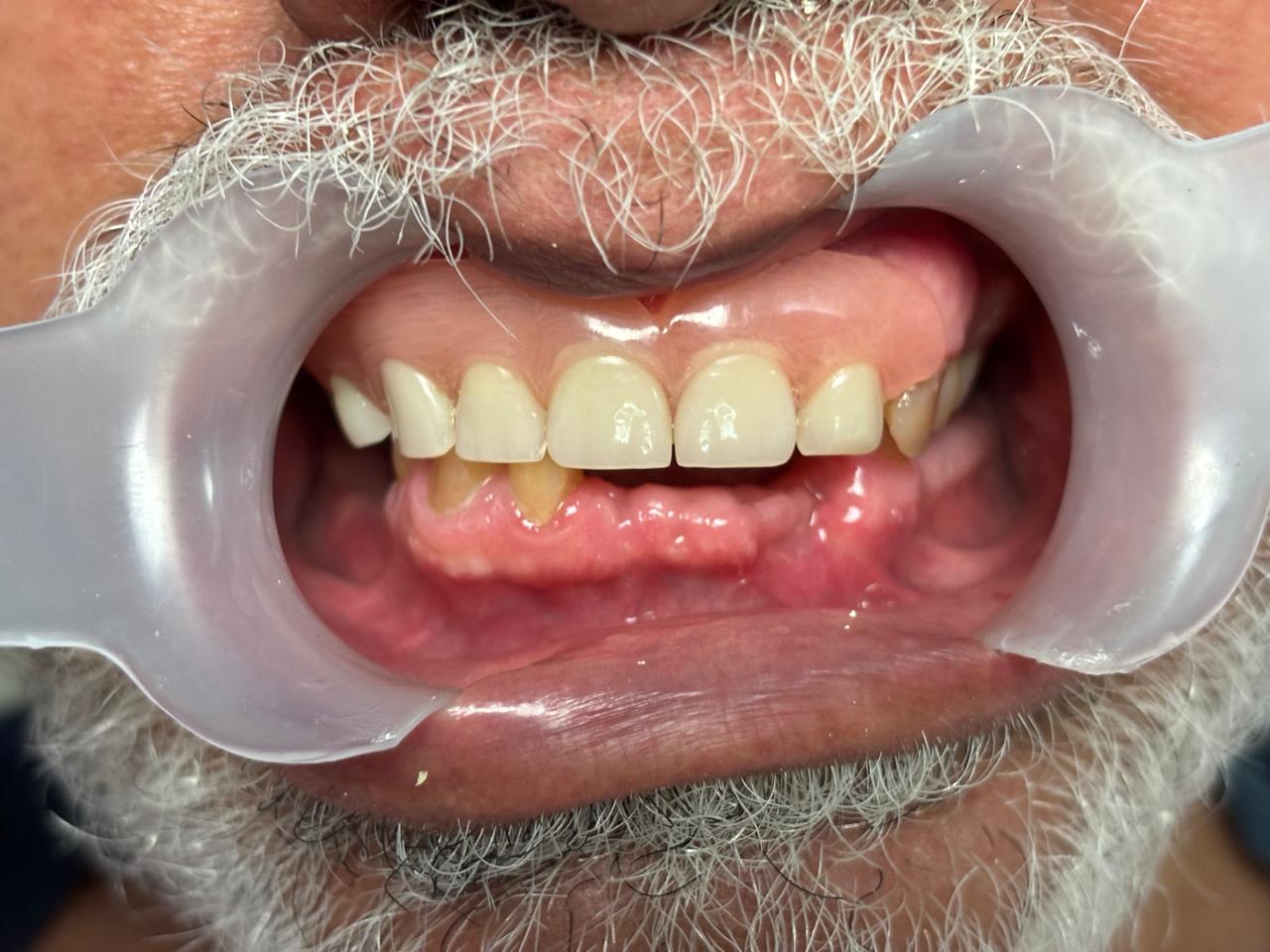 Caso real de restauración con implantes dentales en Especialidades Dentales Monterrey
