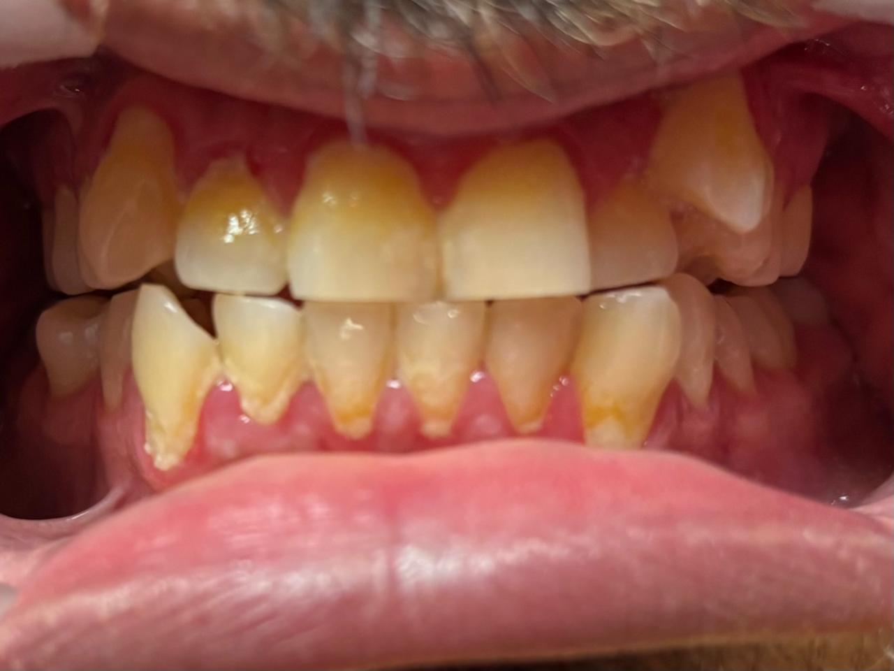 Sarro y gingivitis visibles antes de la limpieza dental profesional