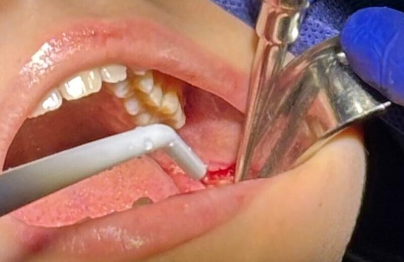 Procedimiento quirúrgico oral relacionado con implantes dentales